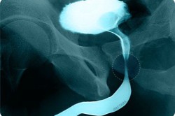 Инфравезикальная обструкция