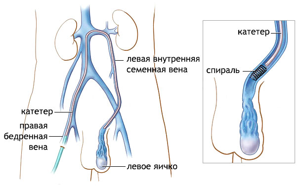 Эмболизация при варикоцеле Эмболизация при варикоцеле