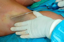 Кюретаж подмышек иглой Кюретаж подмышек иглой