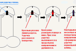 Короткая уздечка члена Короткая уздечка члена