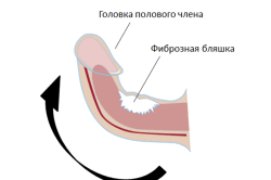 Лечение болезни Пейрони Лечение болезни Пейрони