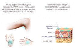 Лечение гипергидроза ботоксом Лечение гипергидроза ботоксом