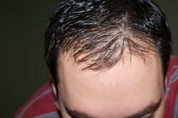 Лечение гнездового облысения цинктералом Лечение гнездового облысения цинктералом