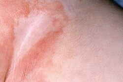 Лечение опрелостей Лечение опрелостей