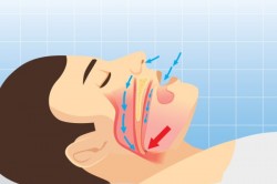 Механизм возникновения храпа