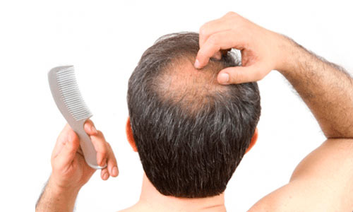 Андрогенетическая алопеция Андрогенетическая алопеция