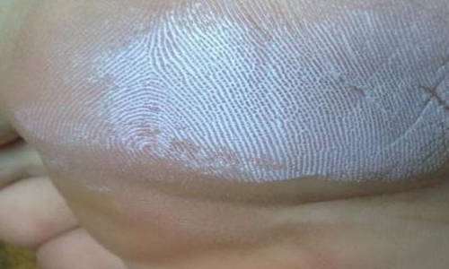 Нанесение пасты на ногу Нанесение пасты на ногу