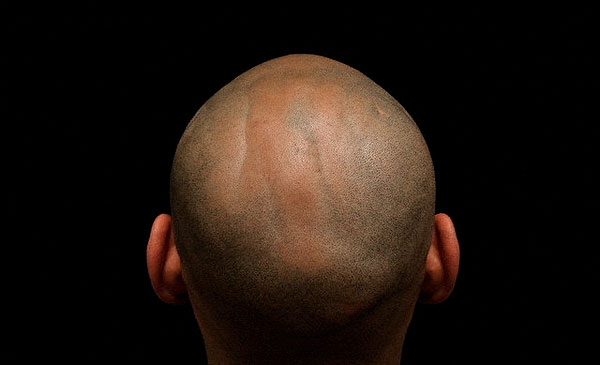 Облысение Облысение