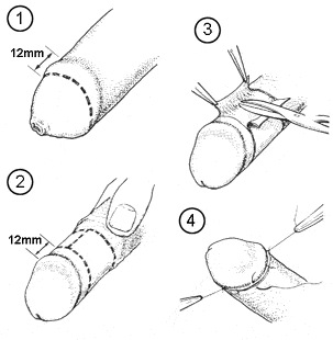 Обрезание по методике Обрезание по методике