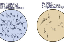 Олигоспермия Олигоспермия