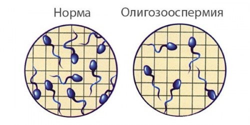 Олигозооспермия