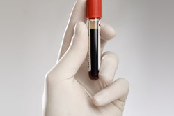 Анализ крови на онкомаркеры Анализ крови на онкомаркеры