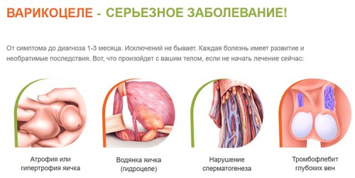 Опасность варикоцеле Опасность варикоцеле