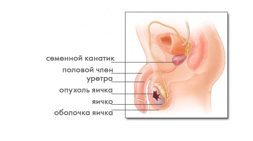 Опухоль яичка Опухоль яичка