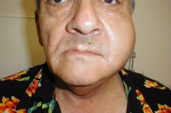 Осложнения при паротите Осложнения при паротите