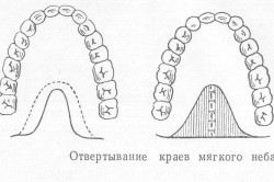 Отвертывание краев мягкого неба Отвертывание краев мягкого неба