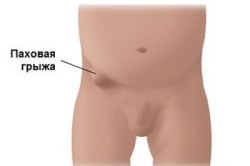 Паховая грыжа Паховая грыжа