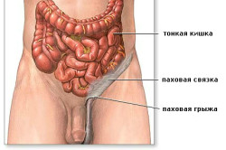 Паховая грыжа Паховая грыжа