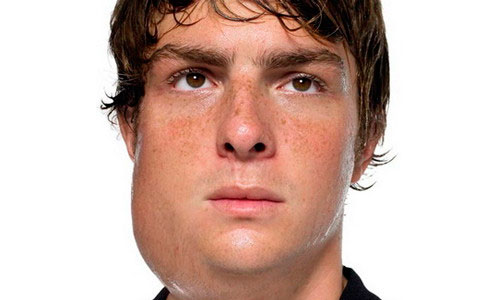 Паротит у мужчин Паротит у мужчин