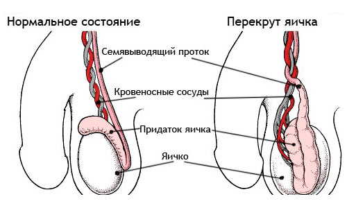 Перекрут яичка