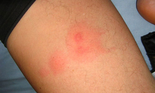 Появление прыщей на ногах Появление прыщей на ногах