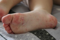 Появление раздражения Появление раздражения