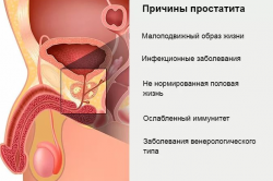 Причины простатита Причины простатита