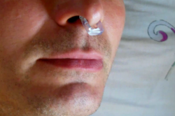 Применение клипсы