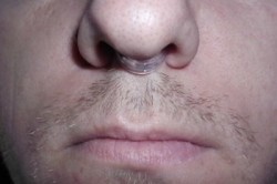 Применение клипсы Применение клипсы