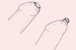 Признаки фимоза Признаки фимоза