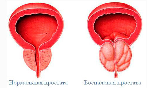 Нормальная и воспаленная простата Нормальная и воспаленная простата