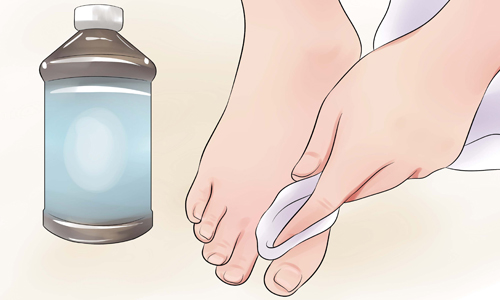 Протирание ноги перекисью Протирание ноги перекисью