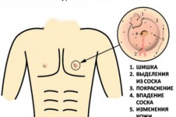 Признаки рака груди у мужчин Признаки рака груди у мужчин