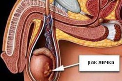 Рак яичка Рак яичка