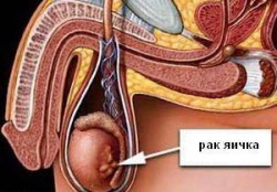 Наглядное пособие рака яичек Наглядное пособие рака яичек