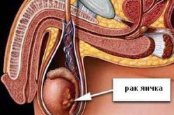 Наглядное пособие рака яичек Наглядное пособие рака яичек