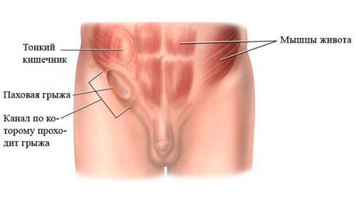 Расположение паховой грыжи Расположение паховой грыжи
