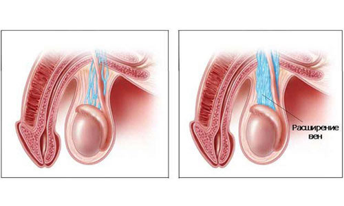 Расширение яичковых вен Расширение яичковых вен