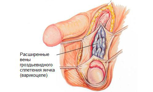 Рисунок 1. Расширение вен яичек и семенного канатика Рисунок 1. Расширение вен яичек и семенного канатика