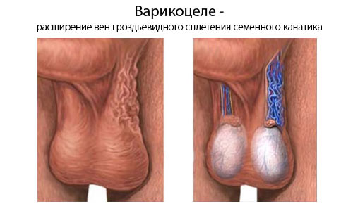 Расширение вен семенного канатика Расширение вен семенного канатика