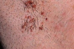 Развитие папиллом Развитие папиллом