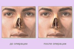 Резекция носовой перегородки