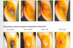 Результаты лечения