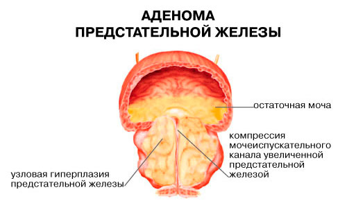 Аденома предстательной железы Аденома предстательной железы