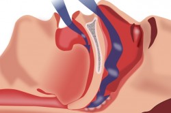 Схема формирования условий храпа Схема формирования условий храпа