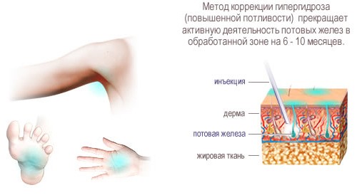 Схема инъекции Схема инъекции