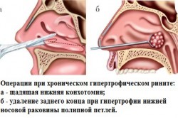 Схема конхотомии