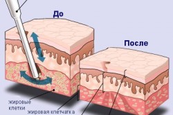 Схема липосакции Схема липосакции