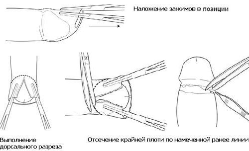 Схема обрезания крайней плоти Схема обрезания крайней плоти