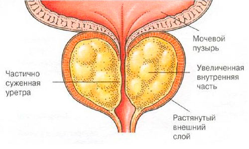 Схема острого простатита Схема острого простатита